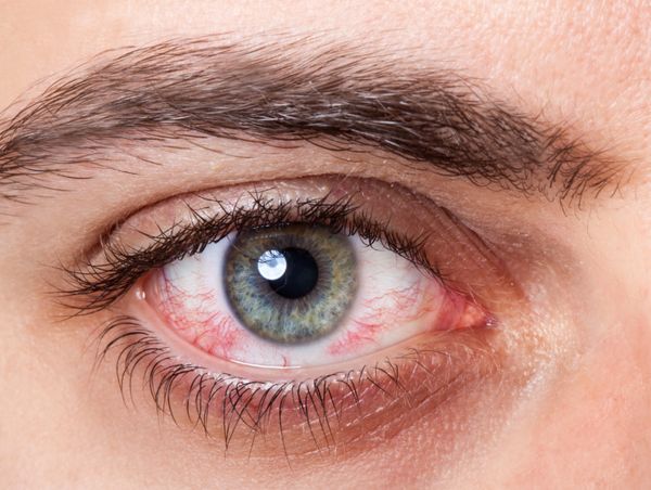 Vörös szem okai és kezelése